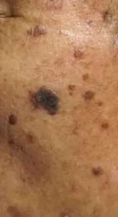 医用皮肤镜什么牌子好【科普】不是所有的“黑痣”都善良，皮肤镜帮您辨真伪_https://www.jmylbn.com_新闻资讯_第5张