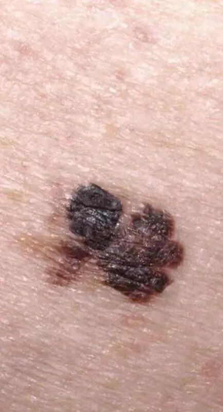 医用皮肤镜什么牌子好【科普】不是所有的“黑痣”都善良，皮肤镜帮您辨真伪_https://www.jmylbn.com_新闻资讯_第6张