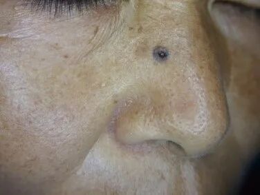 医用皮肤镜什么牌子好【科普】不是所有的“黑痣”都善良，皮肤镜帮您辨真伪_https://www.jmylbn.com_新闻资讯_第3张