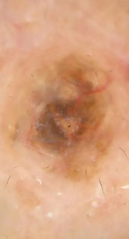 医用皮肤镜什么牌子好【科普】不是所有的“黑痣”都善良，皮肤镜帮您辨真伪_https://www.jmylbn.com_新闻资讯_第7张