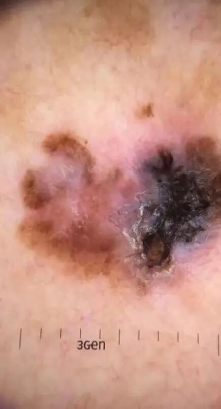 医用皮肤镜什么牌子好【科普】不是所有的“黑痣”都善良，皮肤镜帮您辨真伪_https://www.jmylbn.com_新闻资讯_第9张