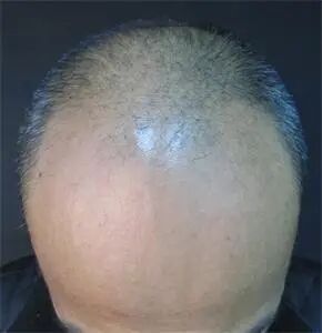 脂溢性脱发（雄激素性脱发）