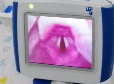 为什么要用可视喉镜新项目推广周系列报道⑤｜可视喉镜插管技术在急诊抢救中的应用_https://www.jmylbn.com_新闻资讯_第8张