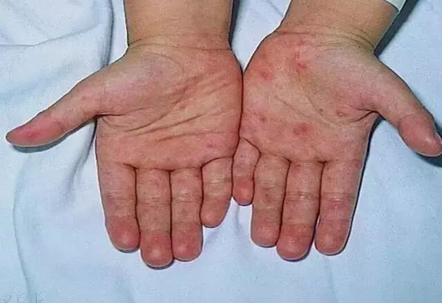 这种病终于有疫苗了,绍兴人怎么接种去哪接种?