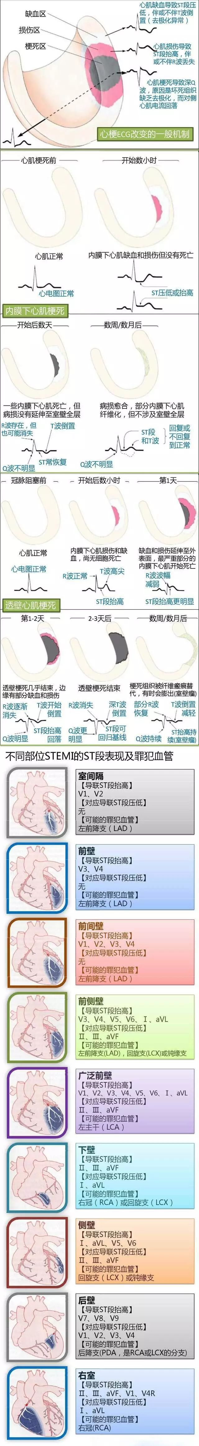 图解心电图！定位心梗犯罪血管