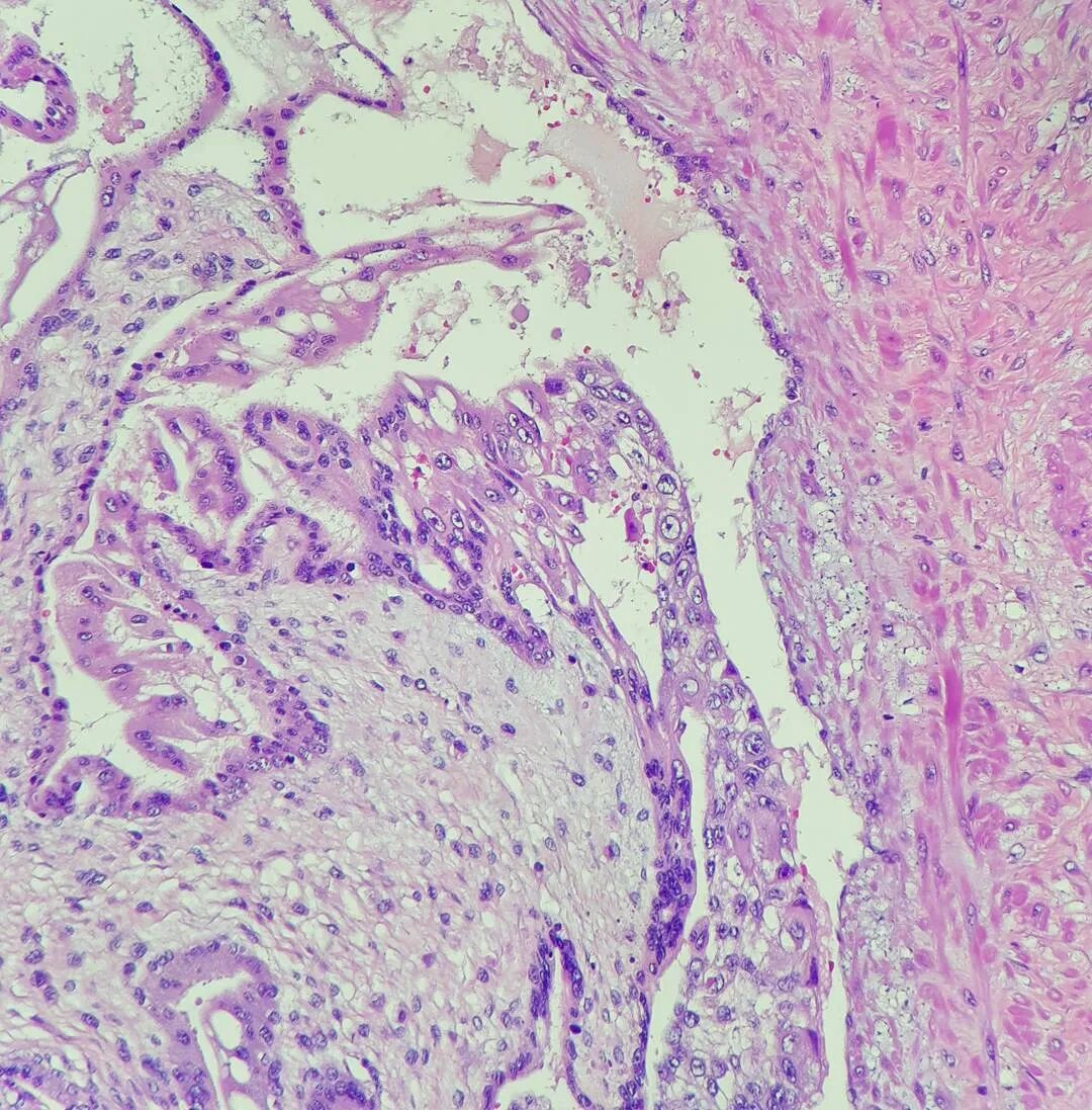 葡萄胎的水泡样组织已超过子宫腔范围,侵入子宫肌层深部或在其他