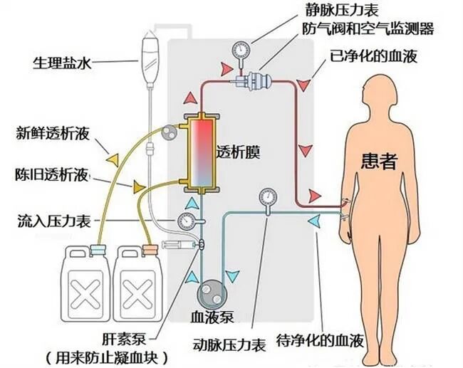 39深呼吸 胡波 没有血管通路 就没有血液透析的机会 暨南大学附属第一医院 广州华侨医院