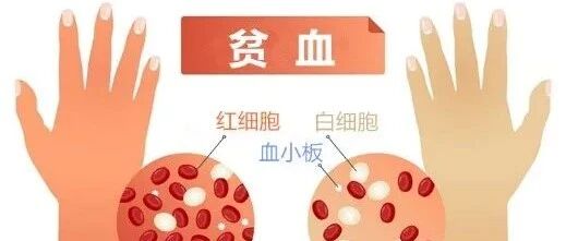 早读 | 贫血让心衰雪上加霜，如何纠正您要知！