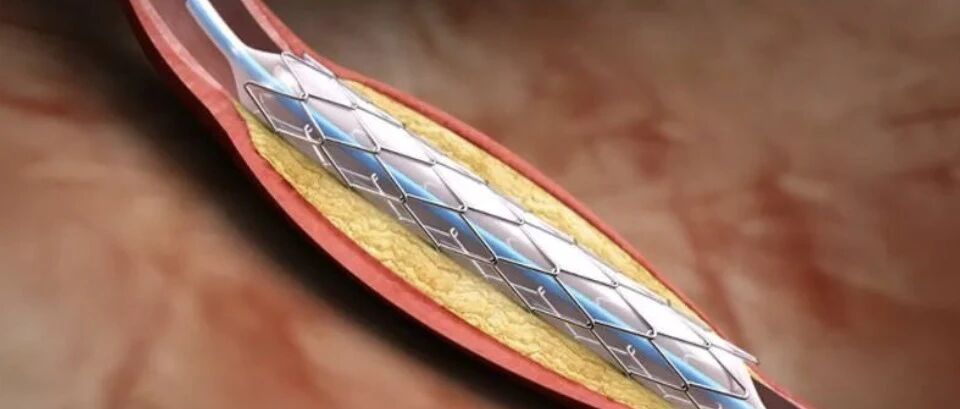 早读 | 稳定型心绞痛如何诊治？看权威指南如何推荐~