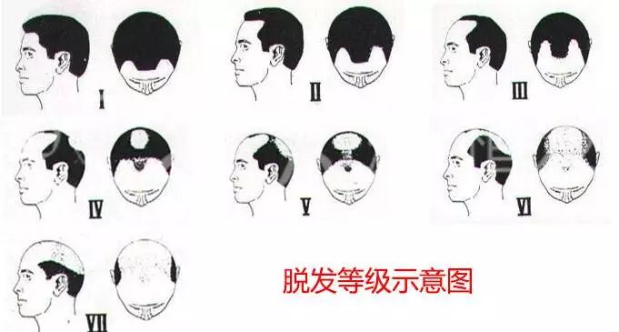 脱发严重等级怎么划分？