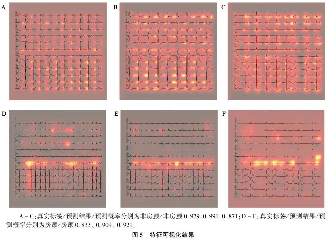 心电图纸怎么看【心电AI】从纸质心电图中识别房颤的人工智能算法研究_https://www.jmylbn.com_新闻资讯_第10张