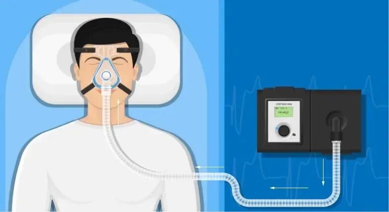 无创呼吸机怎么用【健康科普】如何正确使用家用无创呼吸机_https://www.jmylbn.com_新闻资讯_第1张