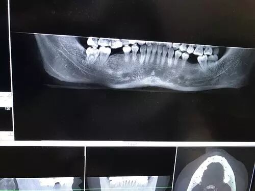 牙齿矫正过程中，智齿只会帮倒忙？