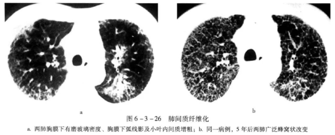 【影像笔记】弥漫性肺间质病变的ct基本表现