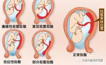 胎盘早剥引起出血 女性科普知识课堂 微信公众号文章阅读 Wemp