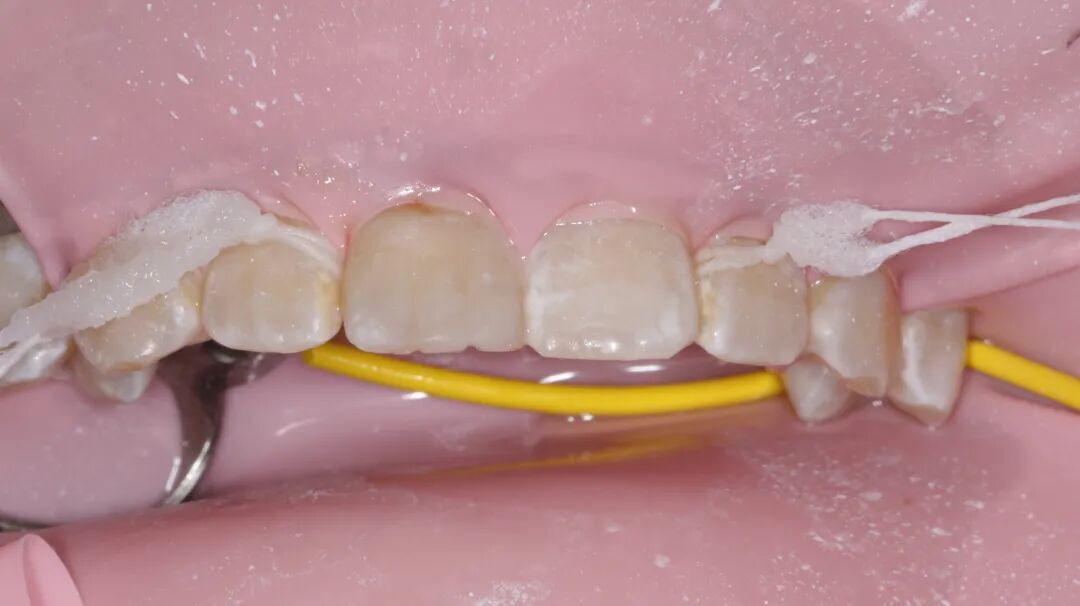 为什么牙医不用开口器特邀牙医【实操病例】集锦{9.22}_https://www.jmylbn.com_新闻资讯_第13张