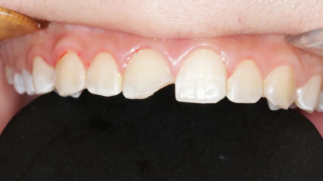 为什么牙医不用开口器特邀牙医【实操病例】集锦{9.22}_https://www.jmylbn.com_新闻资讯_第10张