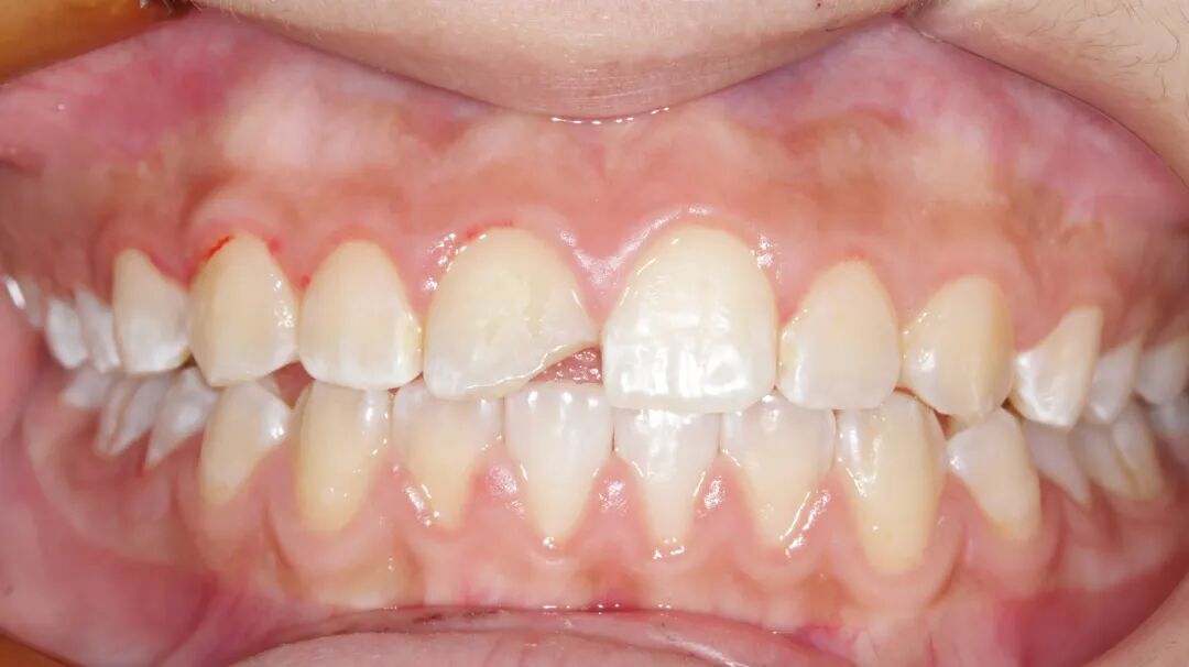 为什么牙医不用开口器特邀牙医【实操病例】集锦{9.22}_https://www.jmylbn.com_新闻资讯_第9张