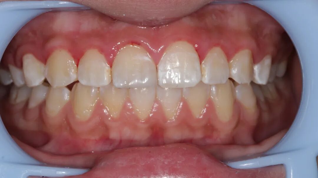 为什么牙医不用开口器特邀牙医【实操病例】集锦{9.22}_https://www.jmylbn.com_新闻资讯_第15张