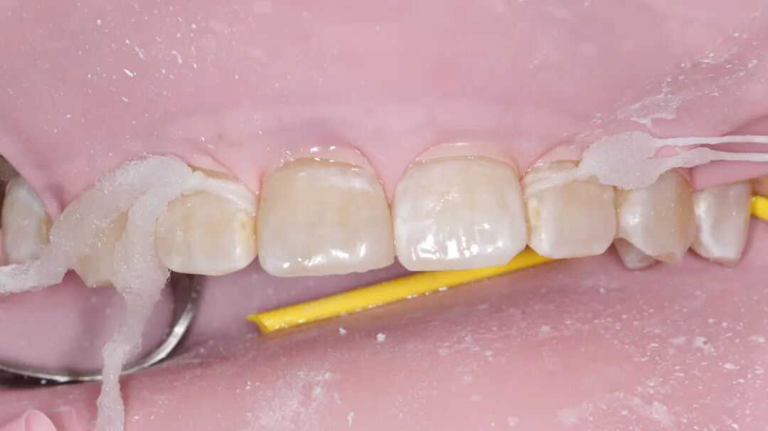 为什么牙医不用开口器特邀牙医【实操病例】集锦{9.22}_https://www.jmylbn.com_新闻资讯_第14张