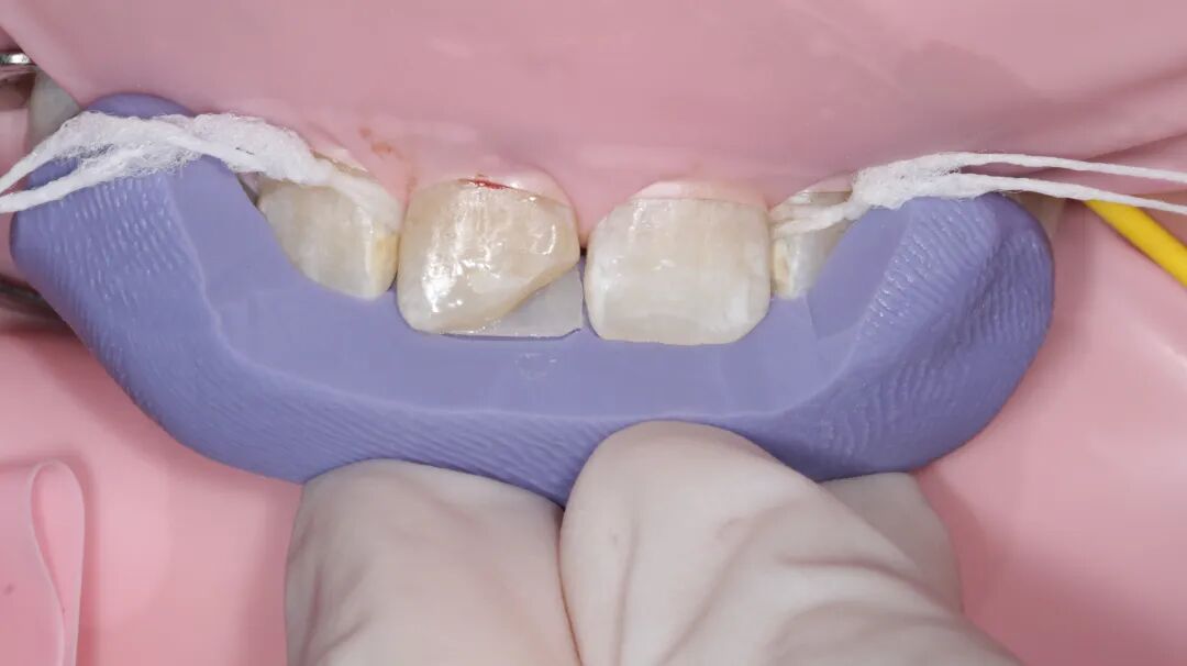 为什么牙医不用开口器特邀牙医【实操病例】集锦{9.22}_https://www.jmylbn.com_新闻资讯_第11张