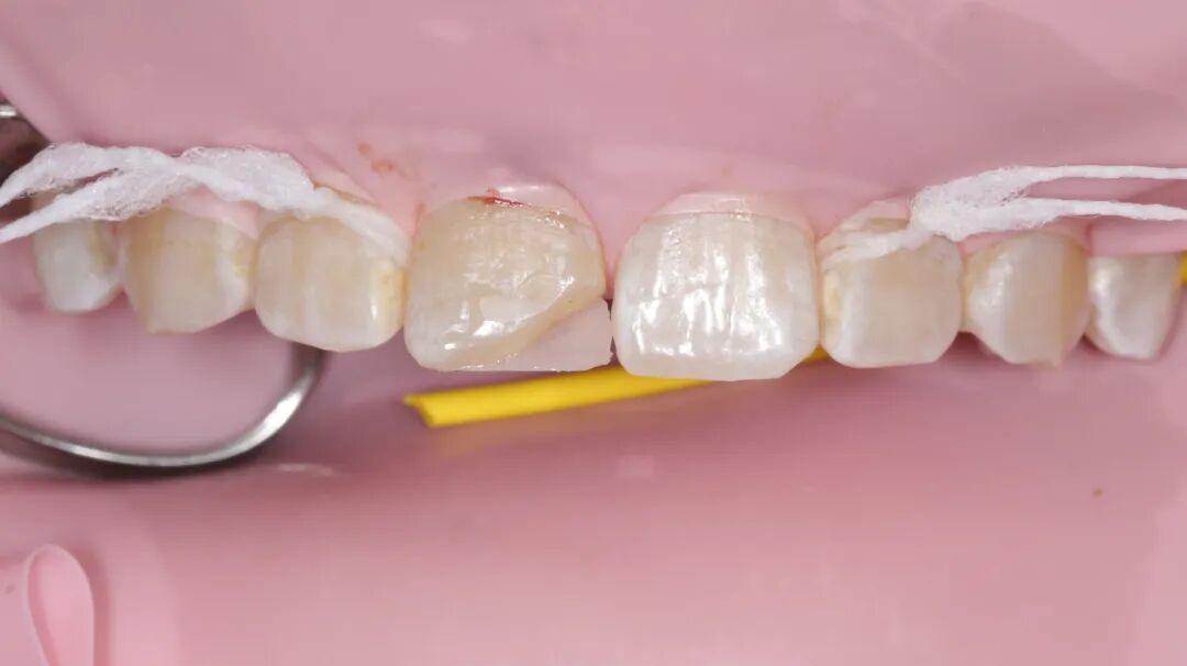 为什么牙医不用开口器特邀牙医【实操病例】集锦{9.22}_https://www.jmylbn.com_新闻资讯_第12张