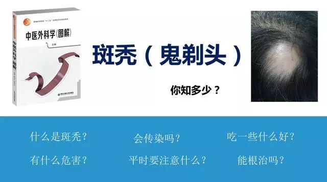 斑秃（鬼剃头）能治愈吗？有传染性吗？平常注意些什么才不容易掉头发？