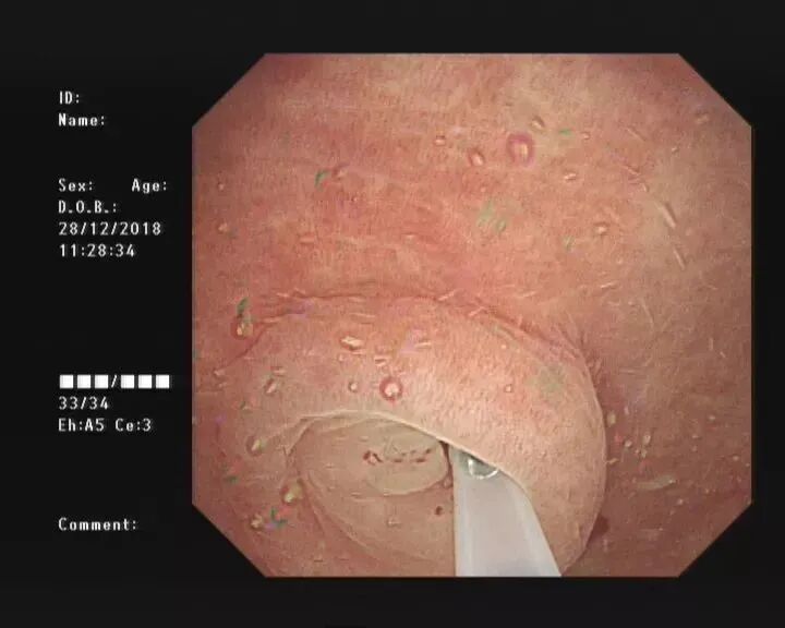 斑马导丝是治疗什么的阑尾炎也可以不开刀——内镜逆行性阑尾炎治疗术（ERAT）_https://www.jmylbn.com_新闻资讯_第4张