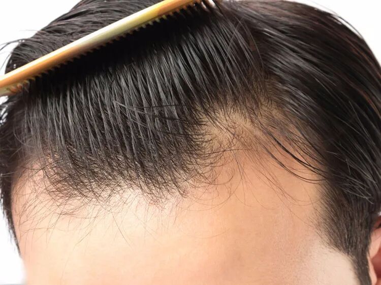 发际线一后退，人生都跟着后退……