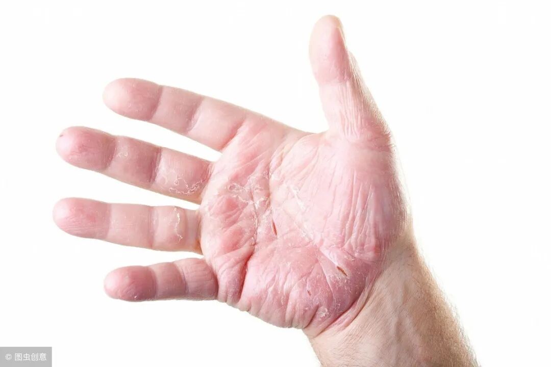 能治疗银屑病（牛皮癣）的中成药，一种能治玫瑰糠疹、神经性皮炎