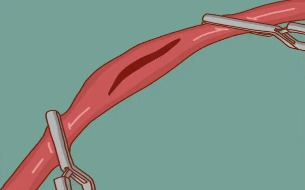 为什么叫哈巴狗钳外科手术特色武器——哈巴狗夹_https://www.jmylbn.com_新闻资讯_第2张