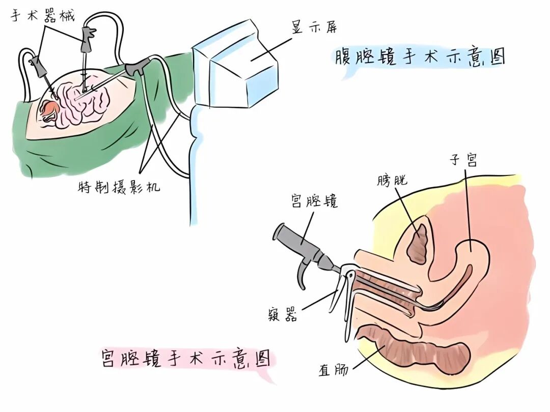宫颈活检器械长什么样小宫腔，大世界丨带你认识宫腔疾病检查神器“ 宫腔镜 ”_https://www.jmylbn.com_新闻资讯_第10张