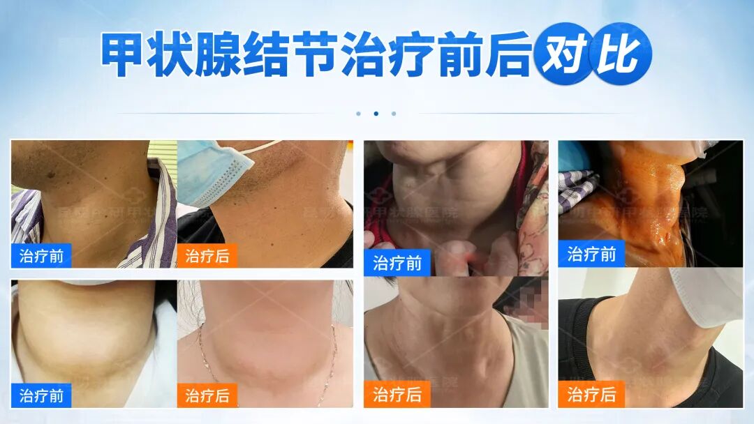 微波治疗机怎么使用多模态超微创微波消融技术治疗甲状腺疾病，实现微创、无痕、保腺体！_https://www.jmylbn.com_新闻资讯_第7张