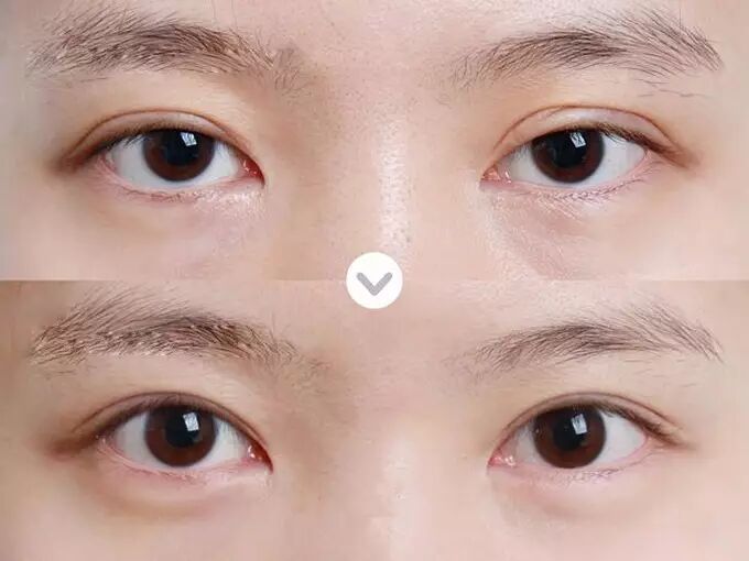 上眼睑下垂很容易造成眼睛无神,建议提肌手术,指的就是下图这种.