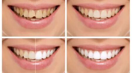 牙病自己就能查？别让牙掉了再去查！