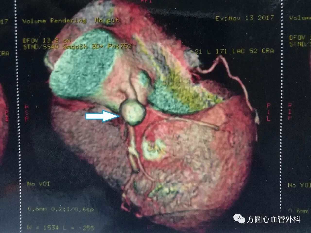 左冠状动脉瘤右冠窦瘤1例