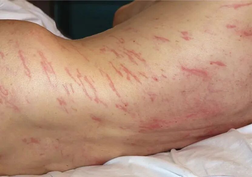虫子在他皮肤下滑行肉眼可见这病有生命危险
