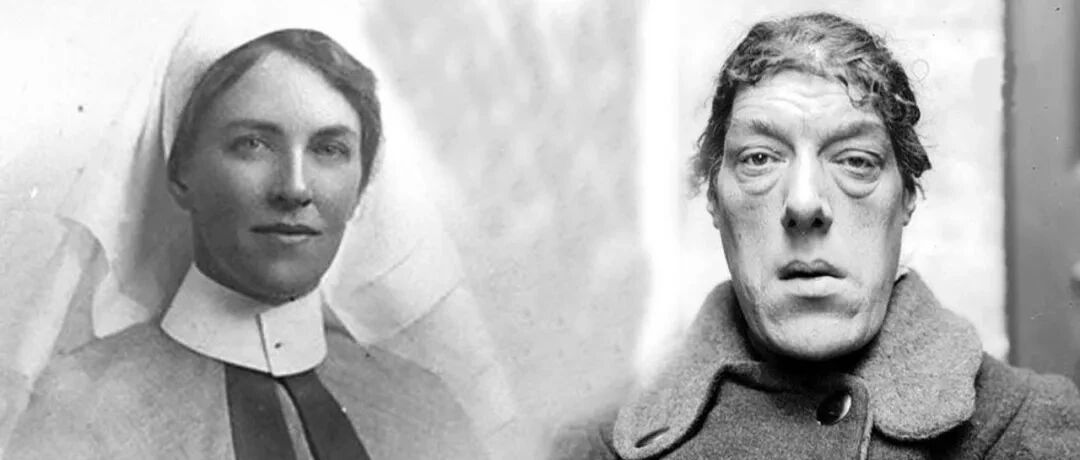 长成美人后，人体重要激素又让她长成“世上最丑的人”