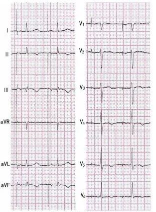 为什么双极不起博心房不同部位起搏，心电图特征一文详解_https://www.jmylbn.com_新闻资讯_第8张