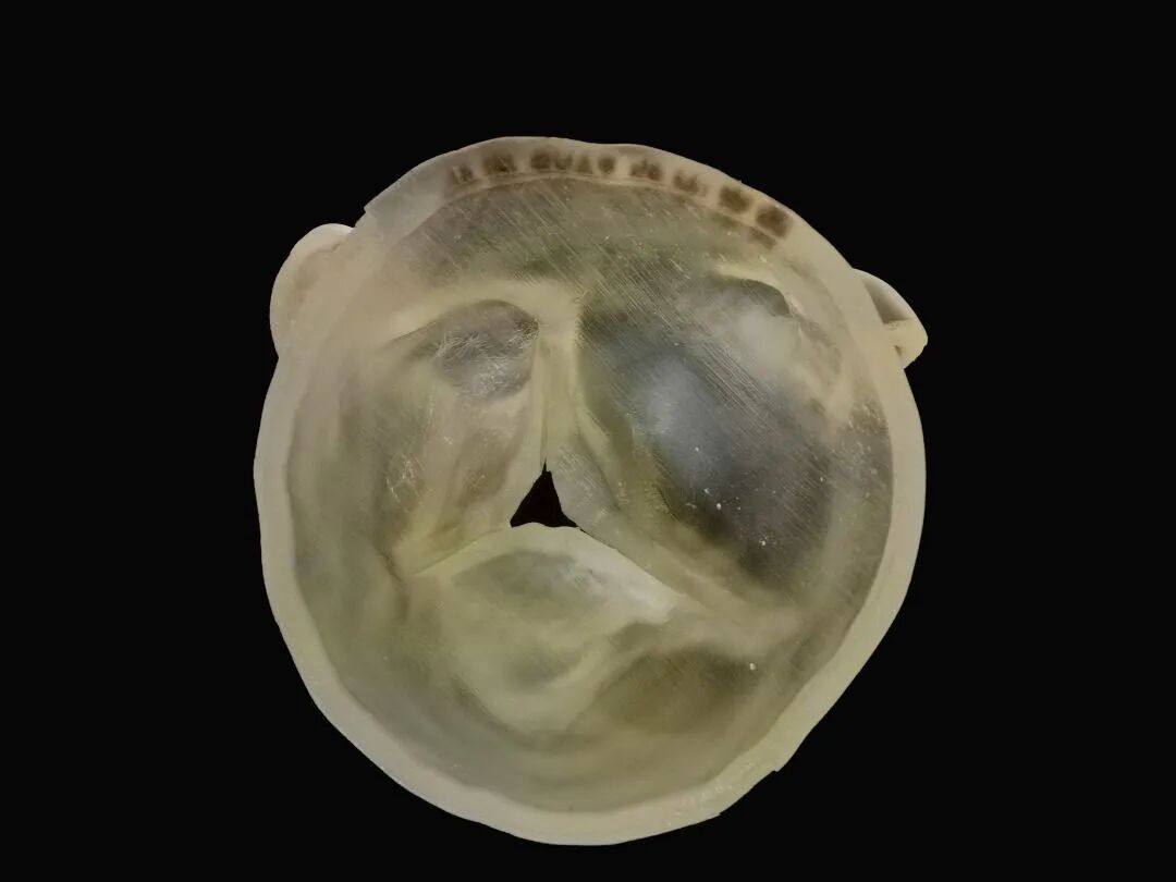 升主观左冠居中术中根据造影检查定位键分布情况将支架瓣膜送入相应