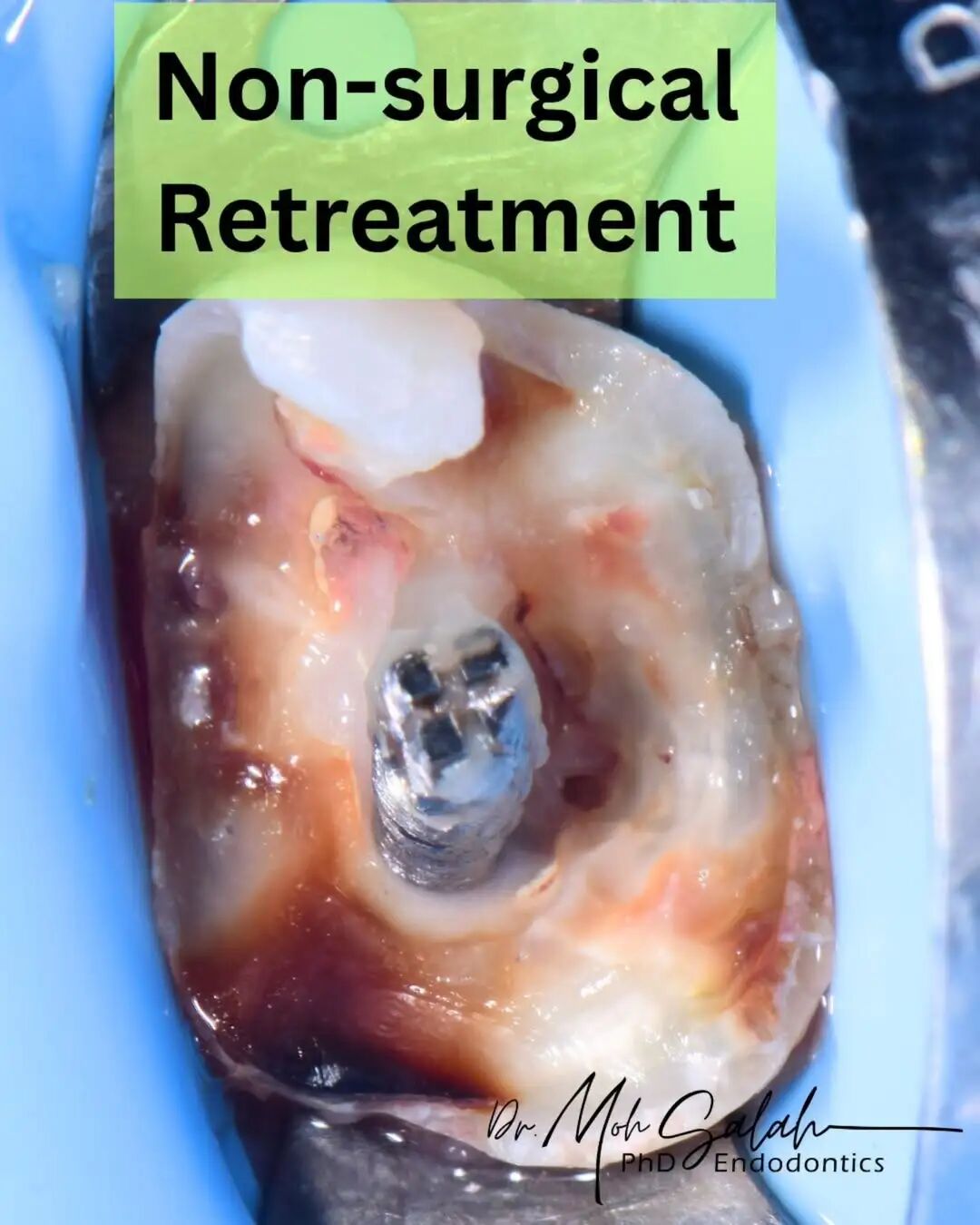 看伊朗牙体大夫的一例根管再治疗