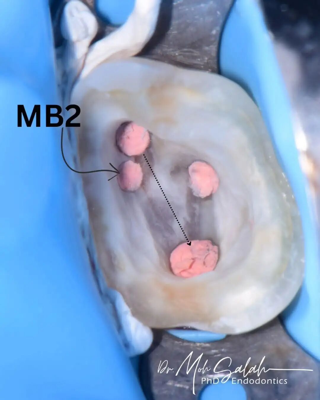 看伊朗牙体大夫的一例根管再治疗