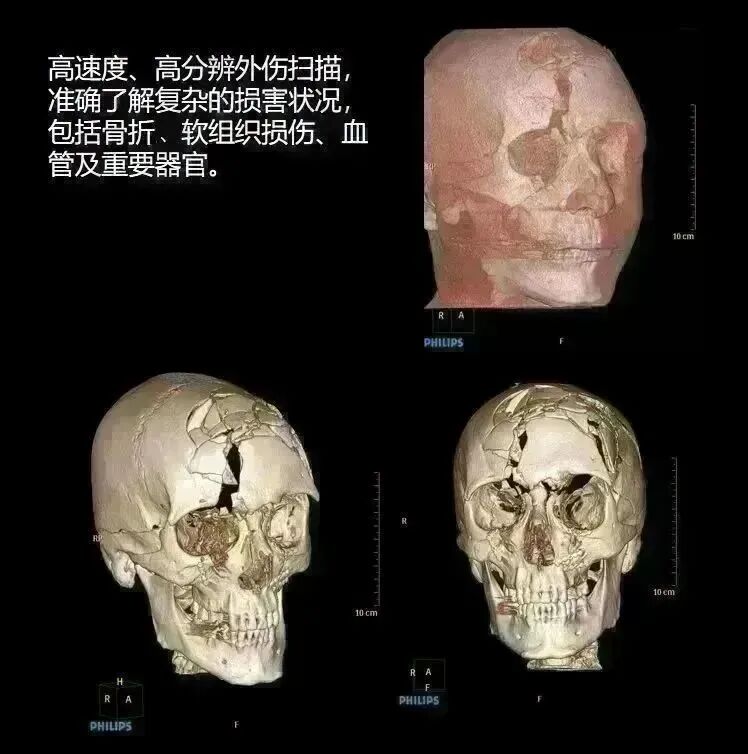 飞利浦都有哪些系列CT设备再升级 ｜ 飞利浦极速ICT，更大程度满足影像检查需求！_https://www.jmylbn.com_新闻资讯_第7张