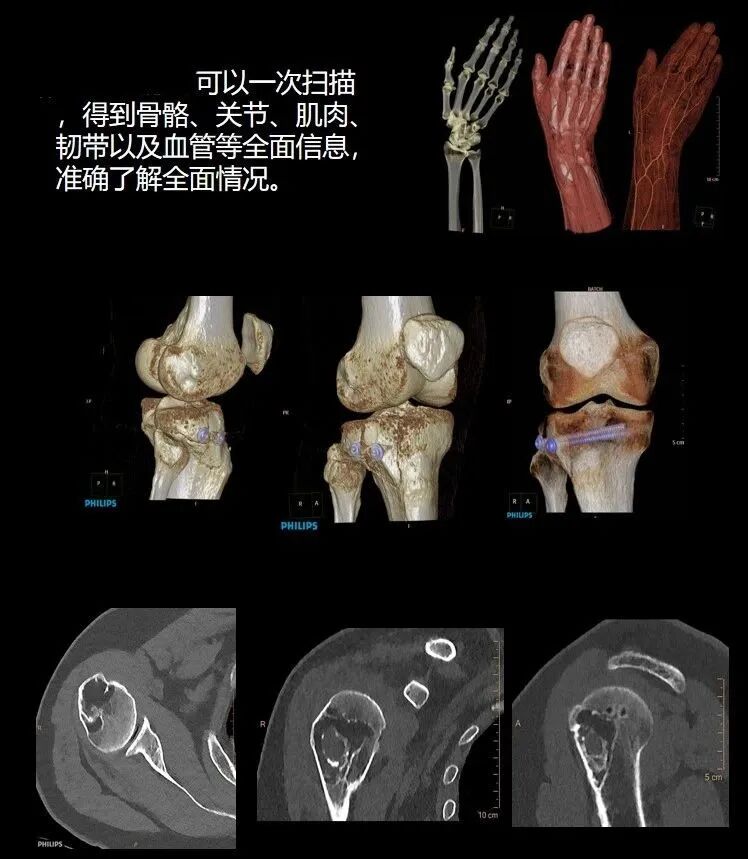 飞利浦都有哪些系列CT设备再升级 ｜ 飞利浦极速ICT，更大程度满足影像检查需求！_https://www.jmylbn.com_新闻资讯_第16张