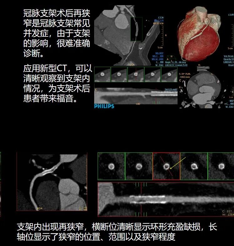 飞利浦都有哪些系列CT设备再升级 ｜ 飞利浦极速ICT，更大程度满足影像检查需求！_https://www.jmylbn.com_新闻资讯_第13张