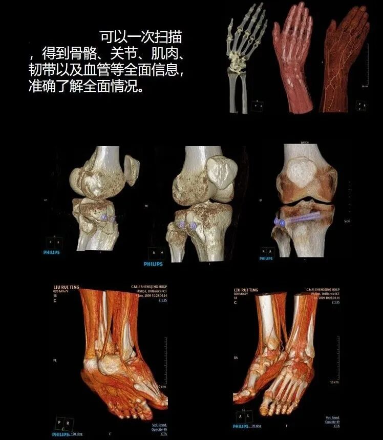 飞利浦都有哪些系列CT设备再升级 ｜ 飞利浦极速ICT，更大程度满足影像检查需求！_https://www.jmylbn.com_新闻资讯_第15张