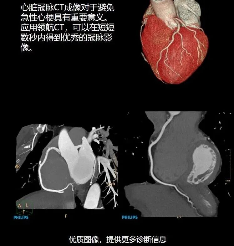 飞利浦都有哪些系列CT设备再升级 ｜ 飞利浦极速ICT，更大程度满足影像检查需求！_https://www.jmylbn.com_新闻资讯_第12张