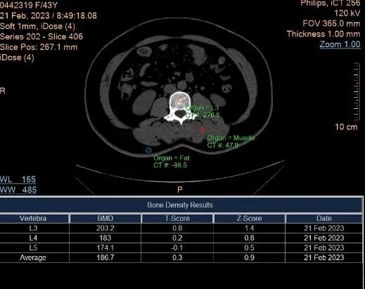 飞利浦都有哪些系列CT设备再升级 ｜ 飞利浦极速ICT，更大程度满足影像检查需求！_https://www.jmylbn.com_新闻资讯_第17张