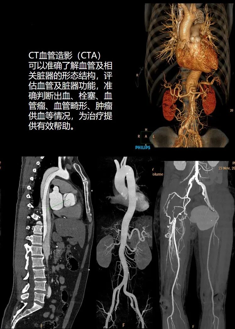 飞利浦都有哪些系列CT设备再升级 ｜ 飞利浦极速ICT，更大程度满足影像检查需求！_https://www.jmylbn.com_新闻资讯_第10张