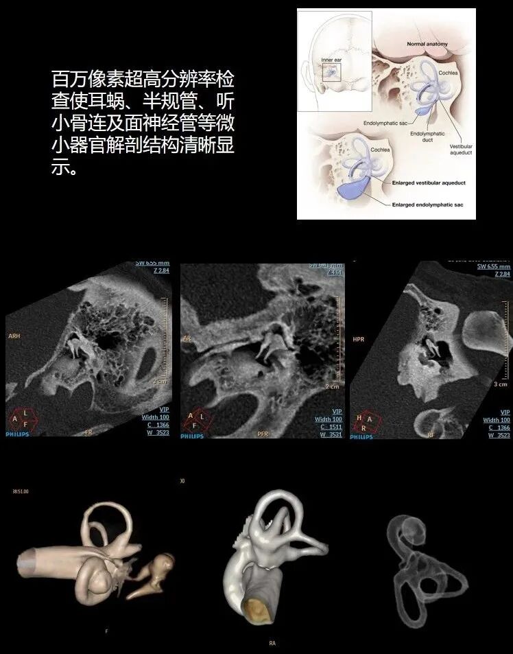 飞利浦都有哪些系列CT设备再升级 ｜ 飞利浦极速ICT，更大程度满足影像检查需求！_https://www.jmylbn.com_新闻资讯_第14张